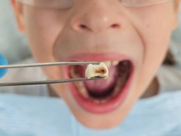 Best Walk-In Emergency Dentist in Cassville, MO